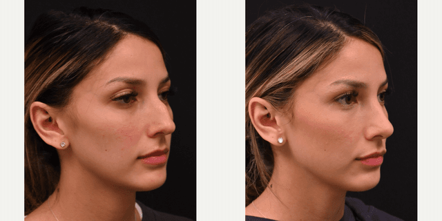 Rhinoplasty (Nose Job) procedure image