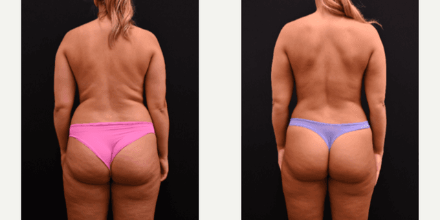 Liposuction procedure image