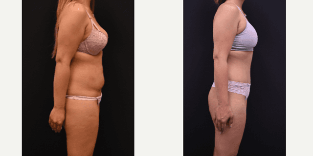 Mommy Makeover procedure image