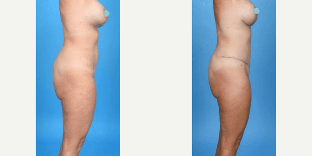 Liposuction procedure image
