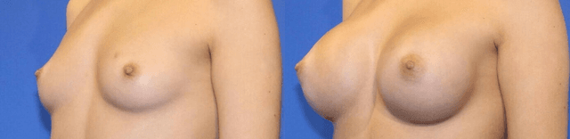 Breast Augmentation procedure image