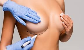 Breast Augmentation procedure image