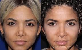 Rhinoplasty (Nose Job) procedure image