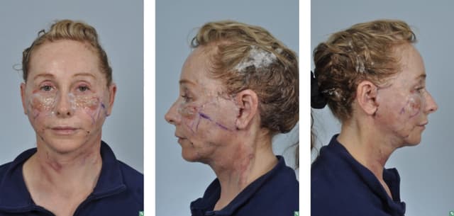 Facelift procedure image