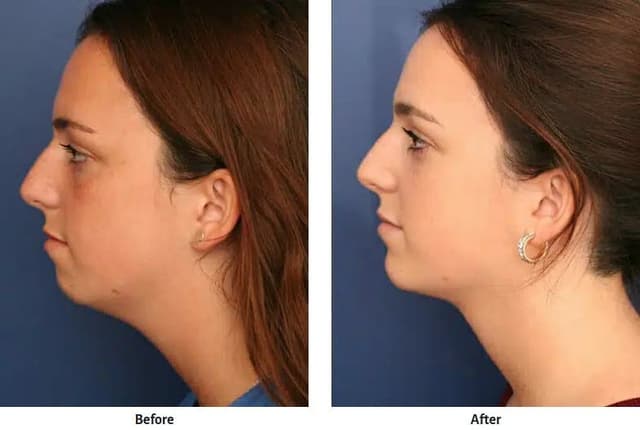 Neck Lift procedure image