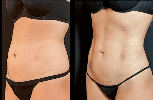 Lipo 360 procedure image
