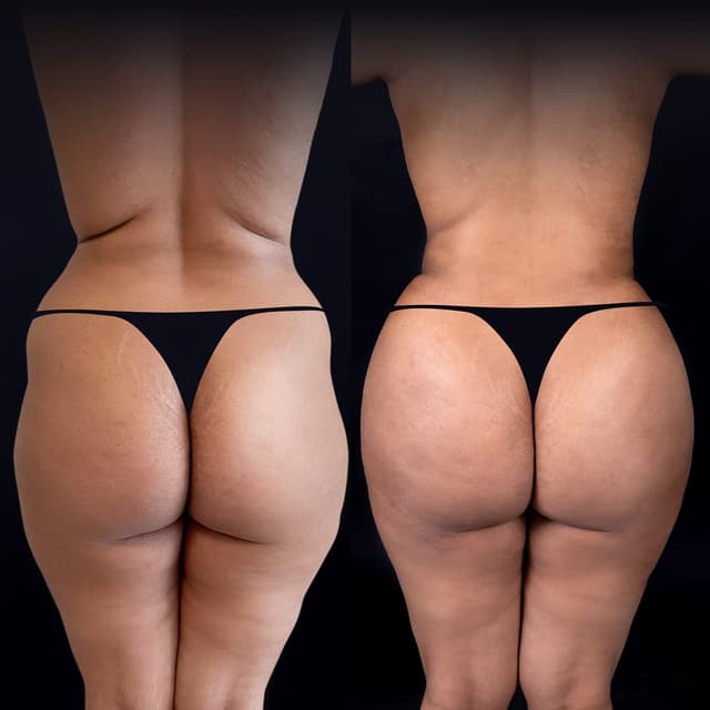 Brazilian Butt Lift (BBL) procedure image