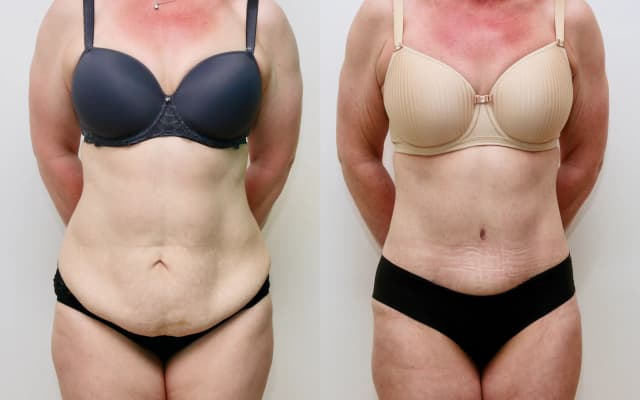 Tummy Tuck (Abdominoplasty) procedure image